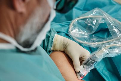 Odstranění křečových žil endovenozní laserovou ablací EVLA