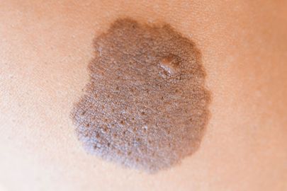 Jak poznat nebezpečné mateřské znaménko?