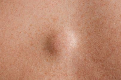 Lipomy: Co vše byste měli vědět