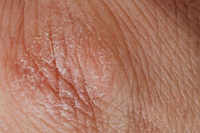 Hlavní příčiny atopického ekzému